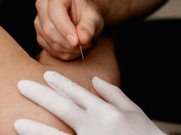 Dry Needling Treatment Zoomed in