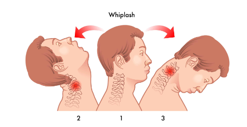 tmj due to whipflash