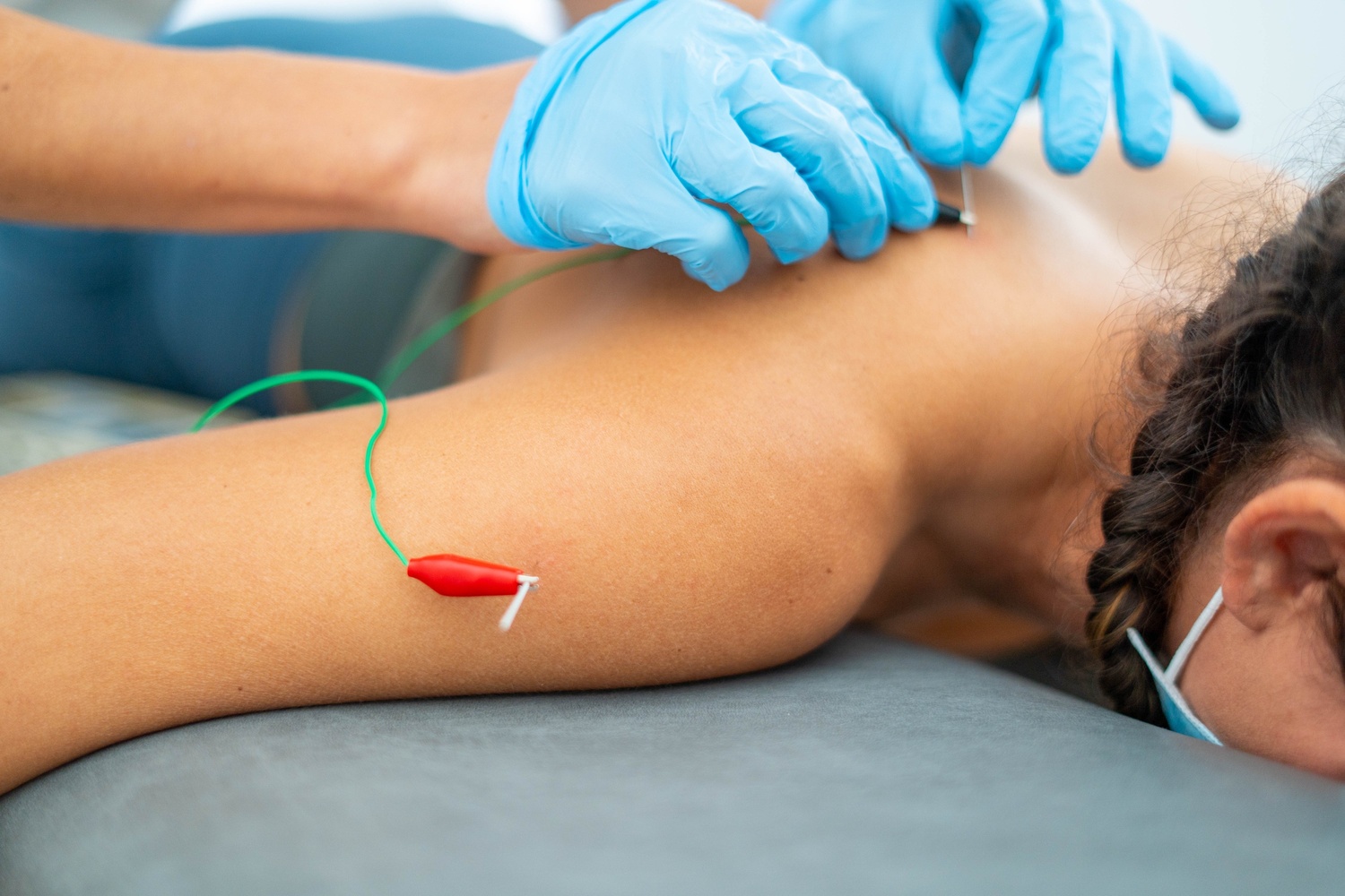 Dry needling